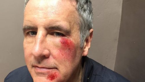 Sky News presenter Dermot Murnaghan reveals hit and run injuries e